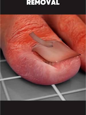 Ingrown Toenail Removal Surgery (3D Animation) #ingrowntoenail #ingrowntoenailremoval #ingrowntoenailsurgery #ingrowntoenailtreatment #ingrowntoenailremovalanimation #toenailremoval #toenailfungus #toenailsurgery #medical3danimation #3dmedicalanimation 