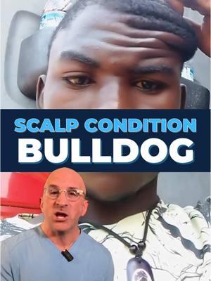 “Bulldog” Scalp or Cutis Verticis Gyrata - Ever heard of "bulldog scalp"? That's the nickname for a fascinating rare condition called Cutis Verticis Gyrata (CVG), where the scalp develops deep folds resembling the surface of the brain! This unique condition affects about 1 in 100,000 males and is even rarer in females (0.026 in 100,000).  . CVG comes in different forms. The primary type appears on its own, while secondary CVG develops due to underlying conditions. While rare, it's seen more often in people with:   - #ConnectiveTissueDisorders (like Ehlers-Danlos Syndrome)   - Hormonal conditions like acromegaly   - Inflammatory #SkinConditions   - Neurological disorders   - Genetic syndromes #RareDiseases The characteristic brain-like folds typically develop after puberty but before age 30. These folds can't be flattened with pressure and usually affect the crown and back of the scalp. The number of folds can range from just 2 to more than 10. Diagnosis is primarily clinical, though doctors may recommend:   - Neurological evaluation   - Skin biopsy   - MRI imaging   - Hormone level testing ...to identify any underlying conditions. . Treatment focuses on maintaining excellent scalp hygiene to prevent secretions from accumulating in the furrows. For those bothered by the appearance, surgical options are available. Small areas can be corrected in one procedure, while larger areas might need multiple surgeries. While CVG is generally harmless and mainly a cosmetic concern, it's important to have it evaluated by a healthcare provider, especially if it develops suddenly or later in life, as this could signal an underlying condition requiring treatment. #Dermatology #connectivetissuedisorder  . Can you name other conditions with higher risk of CVG?