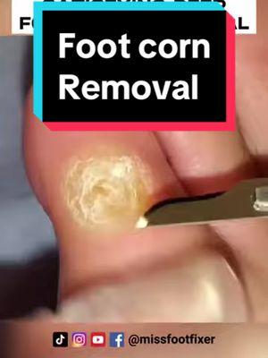 SATISFYING DEEP FOOT CORN REMOVAL BY MISS FOOT FIXER #missfootfixer #deepcornremover #deepcornremoval #deepcorntreatment 