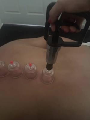 Cupping therapy: An ancient practice with modern benefits! 🌿✨ Here’s how cupping can transform your well-being: 💆‍♀️ Relieves muscle tension 🔥 Reduces inflammation 🌬️ Improves circulation 💖 Promotes relaxation and detoxification Your body deserves this healing touch. Have you ever tried cupping? Share your experience below or book your session today! 💬✨ #CuppingTherapy #HolisticHealing #WellnessJourney #PainRelief