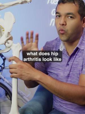 What bone-on-bone hip arthritis actually means, why it happens, and how to treat it 👀 #hiparthritis #hippain