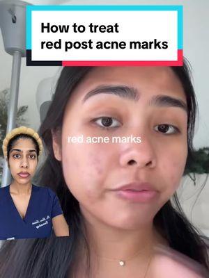 stitch with @arianney how to fade red post-acne marks (post inflammatory erythema) #postinflammatoryerythema #acnescars #fyp  