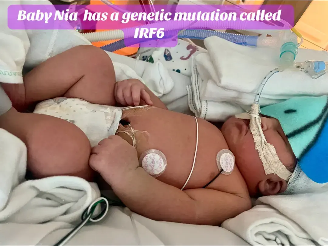 My baby Nia has a long road of reconstruction surgery’s please pray for her. Please help our family anyway you can, such as  medical cost or by reposting this video. We appreciate it. Thank you so much! https://www.paypal.me/narmommy #narmommy #niaalyssaramos #mybaby #vanderwoudesyndrome #poplitealpterygiumsyndrome #irf6 #fyp #💔 #❤️‍🩹 #🫂 #genetics 