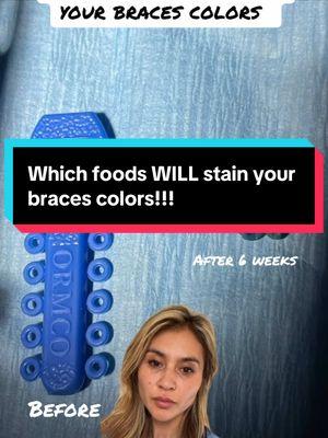 Do you eat these things? 🍝 #bracesoff #bracescolors #orthodontist #orthodontics #bracesfriendly #bracestok #dentaltok #brushyourteeth #oralhealth 