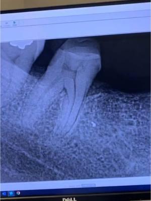 Root canal therapy of teeth #29 and #31. #endodontics #endodontist #dentistry #dentist #dentists #dentistryschool #dentalschool #dentalhygienist #dentalassistant #rootcanal #rootcanaltherapy #toothache #tooth #teeth 