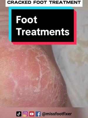 HOW TO TREAT DRY , CRACKED HEELS *** CRACKED FOOT TREATMENT *** BY MISS FOOT FIXER #CrackedFoot #footcracked #foottreatment #missfootfixer 