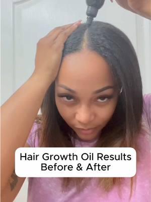 The hype over our viral hair growth oil is real. Here we grow!😉  #hairgrowthoil #rosemaryforhairgrowth #rosemaryoil #hairlosssolutions #hairgrowthjourney #tiktokshopyearendsale 