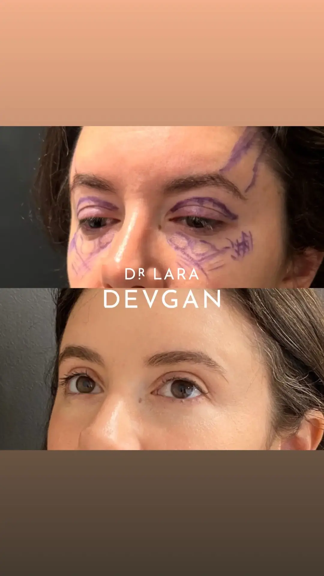 Finesse upper and lower eyelid blepharoplasty, combined with autologous fat grafting and a temporal brow lift, is a transformative approach to achieving natural and harmonious rejuvenation of the upper third of the face. This meticulous technique addresses excess eyelid skin and puffiness while restoring youthful contours with precise redistribution of volume. Autologous fat grafting subtly replenishes lost fullness in the periorbital region, enhancing brightness and symmetry, while the temporal brow lift gently elevates the outer brow, creating an open and refreshed appearance. Together, these procedures offer a global refinement, delivering subtle yet striking results that brighten the eyes and restore a naturally beautiful, youthful expression. #beautyisinthedetails #devganoptimization #facialoptimization #boardcertifiedplasticsurgeon 