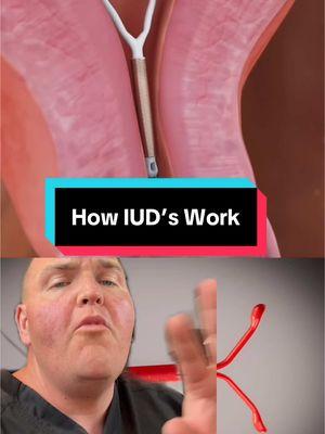 It seems that many doctors don’t have time for this level of explanation, so let’s talk about how IUD’s (intrauterine devices) work. #womenshealth #anatomy #science  #birthcontrol