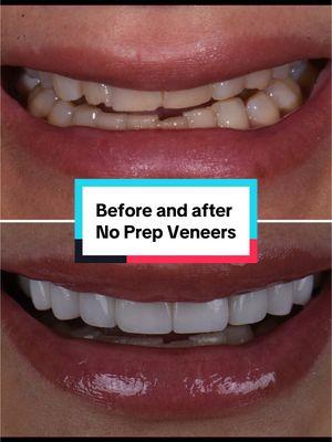 Before and after of no prep, no shaving, no filing of the teeth for porcelain veneers #noprepveneers #veneers 