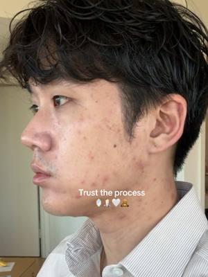 Trust me ive tried everything when it comes to acne and the only thing that worked for me is a consistent skincare routine #acneproneskin #acnetransformation #acneskincare #acnescars #kbeauty #koreanskincare #koreanboys #glassskin 