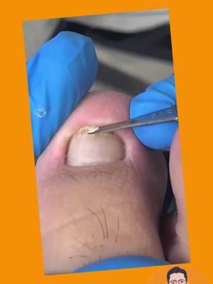 #nails #toenail #toenailremoval #ingrowntoenail #satisfyingvideo #foryourpage #oddlysatisfying 