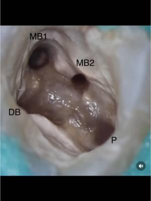 Location of an mb2. #endodontics #endodontist #dentistry #dentist #dentists #dentistryschool #dentalschool #dentalhygienist #dentalassistant #rootcanal #rootcanaltherapy #toothache #tooth #teeth 