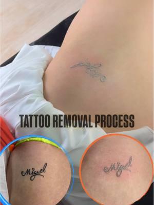 This is the process of a tattoo removal not pain. Do you have a tattoo that you want to remove?#tattooremoval #removals #miami 