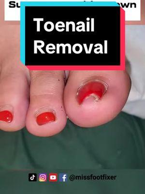 Super curved ingrown toenail removal by foot specialist miss foot fixer #ingrowntoenail #ingrownnail #ingrowntoenailremoval #missfootfixer 