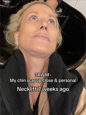 Neck lift revision turned into a complete mess for my plastic surgeon. I had extensive scar tissue and the bands were not together at all. Dr Robinson had to do a complete rebuild and extensive repair to my necklift. He was not the original surgeon. 56 years old. @Dr.Brent.Robinson @The Plastics Clinic + Spa #fyp #foryoupage #fypシ゚viral #fy #necklift #doublechin #over50 #plasticsurgery #aging #botched #revision #neck #grwm #blowout #hairtok #extentions #jzstyleshairextensions #designer #notsponsored #scar #scartissue #liposuction 