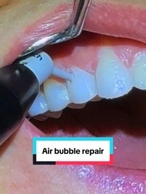 a super easy fix! 🦷 #dentistsoftiktok #airbubbles #cure #temporary #veneer #dentistry #dentist #dentistlife 