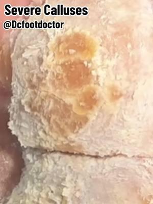 Severe Callus removal #callus #podiatry #footdoctor #podiatrist #dcfootdoctor #foot #feet #footcare #doctorsoftiktok #feetofticktock #diabetes #neuropathy #calluses #callusremoval 