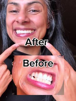 Results may vary! But for me it works like a charm to whiten my teeth! #whitening #whiteningteeth #whiteningpen 