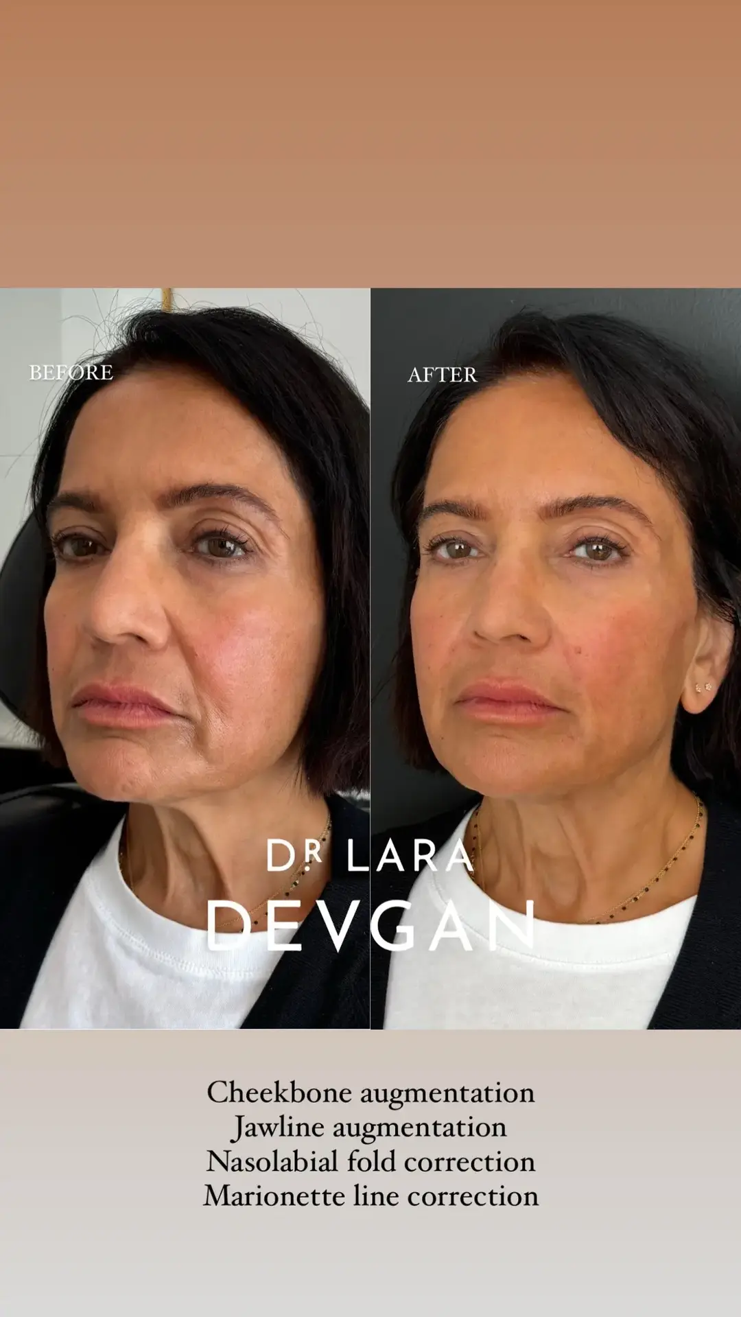 When I approach cheekbone and jawline augmentation, my focus is on combining anatomic expertise with meticulous tissue handling to achieve natural, balanced results. Every patient’s facial structure is unique, and my goal is to enhance their features while respecting the underlying anatomy. I carefully analyze bone structure, soft tissue volume, and skin quality to design a treatment plan that complements their natural contours. With precise injection techniques and a deep understanding of facial proportions, I can create subtle enhancements that bring out the best in my patients’ appearances without looking overdone. My commitment to meticulous technique ensures minimal disruption to the tissues, prioritizing safety and long-lasting, harmonious results that leave my patients feeling confident and authentically themselves. #beautyisinthedetails #facialoptimization #plasticsurgery #plasticsurgeon 