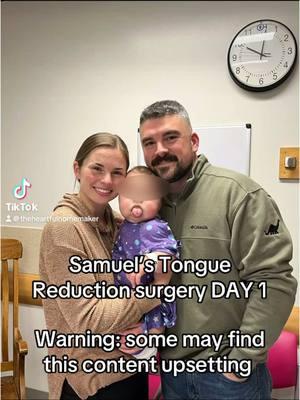 Samuel Tongue Reduction surgery day 1 #beckwithwiedemannsyndrome #geneticdisorder #awareness #medicallycomplex #overgrowthdisorder #macroglossia #baby #tonguereduction #babysoftiktok #surgerytiktok #fyp #foryoupage 