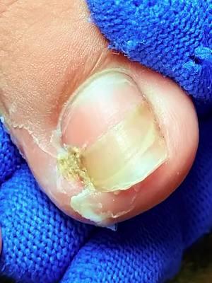 #ingrowntoenail #ingrowntoenailremoval #ingrownnail #ingrown #ingrowntoenailsurgery #infectedingrowntoenail #toenails #fyp #satisfying #usa_tiktok #usa🇺🇸 #nails #tiktokuk🇬🇧 #feetnails 