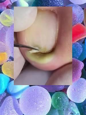 #toenails #ingrowntoenail #toenailremoval #nails #toenail #satisfyingvideo #fyp