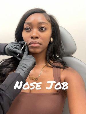 Nose Job by @OVME Official 🤭 except it’s a Botox nose job. Also they can use it to lift your nose tip, but I didn’t need that. Yall know I love my smile line filler. The gummy smile Botox is a game changer thooo.  #nosejob #botoxnosejob #smilelines #smilelinefiller #gummysmile #gummysmilebotox #blackgirlfillers #medspa #ovme #rhinoplasty 