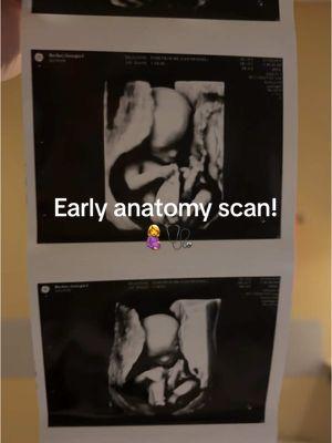 anatomy scan day! #pregnant #surrogacy #surrogate #surrobaby2024 #gestationalsurrogacy 