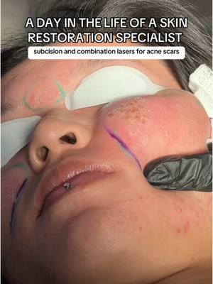 In this part of the treatment, I’m focusing on breaking up deep, pitted acne scars using a combination of subcision and advanced lasers. These scars are often tethered to the underlying tissue by fibrous bands, which is why subcision is such a critical first step in their treatment. Subcision involves using a fine needle to carefully release these tethered bands, allowing the skin to lift naturally. This process not only smooths the appearance of the scars but also triggers the body’s natural collagen production, helping to rebuild the skin’s structure from the inside out. After subcision, I use a combination of lasers, including the CO2 laser and Erbium laser, to resurface the skin and further break down scar tissue. The CO2 laser targets the deeper layers of the skin, vaporizing damaged tissue and stimulating collagen remodeling. The Erbium laser gently removes the outermost layers of damaged skin, refining texture and enhancing overall smoothness. Got questions about this process, your skincare or treatment options? Join me live Monday through Thursday at 9 PM PST on TikTok, Instagram, YouTube, and Twitch. I’ll be answering your questions, giving honest, unsponsored advice, and sharing recent results.   Self-book your consultation today at doctorqazi.com Call/text: 949-336-7293 Whatsapp: +1 (714)-860-6945 20271 SW Birch St Suite 100, Newport Beach, CA 92660   #acnescars #acnescartreatment #acnescar #icepickscar #boxcarscar #rollingscar #subcision #taylorliberatorsubcision #acne #doctorqazi #qazicosmeticcenter #dayinthelife #doctorvlog #NewportBeach #co2laser #ablativeco2laser 