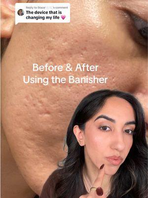 Replying to @Stace🫧🫧 #greenscreen some results from using the banisher! #skincaretreatment #acnescars #acnescartreatment #banishacnescars #dermastamp 