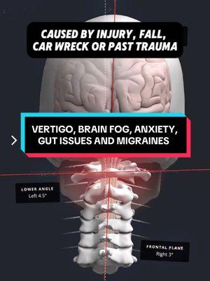 The Cranio-Cervical Junction is the most important area in the human body, yet no one checks it.  If there’s structural misalignment in the CCJ area it will create:  • Imbalnces in the nervous system  • Vagus Nerve Dysfunction  • Restrict blood flow getting to the brain.  • Diminsh CSF flow If you’ve been suffering with unusual neurological symptoms and no one has an answer.  The solution may be in Upper Neck.  Comment Below if this describes you!  #CapCut #vertigo #dizziness #uppercervical #fyp #neckpain #medicalmystery #anxiety #guthealth #gutissues #brainfog 