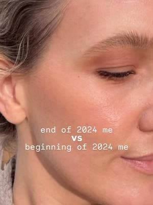 2024 : the year I aged BACKWARDS. 🙏🏼💕✨ All thanks to waterless beauty. It’s time to get WATER OUT 🚫 of your skincare products.  What does mean to be waterless? 💦🚫 They replace the number ingredient - water (which is 70% of the product) - with a super potent anti-oxidant olive leaf elixir. 🌿🫒✨ #GlowUp #skincare #holsiticskinare #skincarethatworks #bioactive #bioactiveingredients #dryskin #makeup #youthfulskin #glassskin #dewyskin #aginggracefully #waterlessbeauty #waterlessskincare #organicskincare #confidence #beforeandafter #fallinlovewithyourself #skincaretips #antiaging #cosmetics #facial #natural #naturalbeauty #hydroxytyrosol