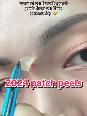 May 2025 bring you your best patch peels yet🙌  #skincare #pimplepatch #acneproneskin #community #2024recap #heroemployee 