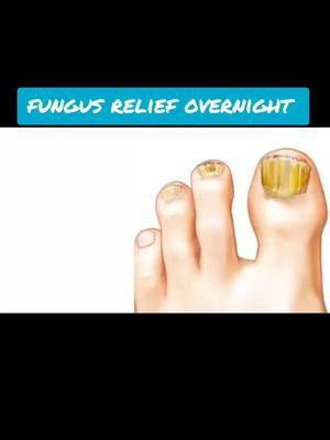 #nailfungus #footcare #nailfungusremoval #nailfungustreatment #m #foothealth #podiatry #diabeticfootcare #nails #podiatrist #toenailfungus #ingrowntoenails #skincare #athletesfoot #toenails #healthyfeet #footdoctor #t #ingrowntoenail #bunions #fungus #feet #footfungus #fungalinfection #toenailfungustreatment #hammertoe #achillestendonitis #nailhealth #pedicure #blogs