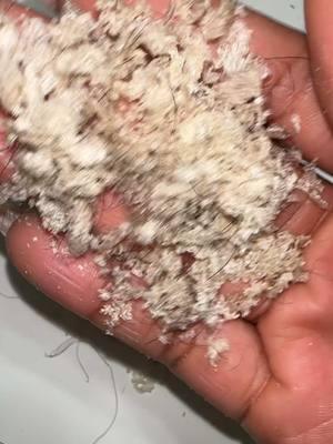 Watch to the end for the pill up 🤢🤣 #sebboricdermatitis #sebborheicdermatitis #flakes #dandruff #dandruffremovel 