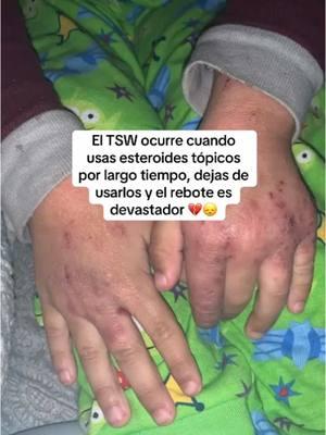 Es curioso como con tanta gente sufriendo de TSW aun hay doctores que niegan que esto es una condición real. Te cuento, uno de los riesgos de usar esteroides tópicos es que éstos tienen efectos secundarios, por eso, advierten de usarlos por un tiempo limitado (corto, menos de tres semanas) y en cantidades moderadas. Cuando se abusa de los esteroides, la piel comienza a volverse dependiente de ellos, pasa como con cualquier adicción, cada vez necesitas dosis más fuertes para sentirte mejor. Cuando dejas de usar estas cremas con esteroides y haz abusado de ellas puedes comenzar a sufrir de TSW (síndrome de retirada de corticoides). Esta condición no tiene cura y el cuerpo debe pasar por una etapa difícil de síntomas muy fuertes antes de recuperarse 🥹❤️‍🩹. ‼️Nuestros productos son sin esteroides, funcionan para cualquier tipo de eczema. Hacemos envíos a Puerto Rico, Estados Unidos, Canadá y Reino Unido ✈️ #dermatitisatopica #dermatitisatópica #pielatopica #dermatitisatopik #eczemaskincare #eczema #pielessensibles #USA #estadosunidos #dermatitis