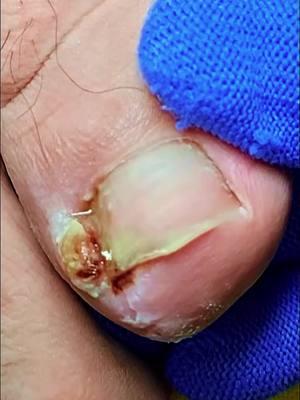 #ingrowntoenail #ingrowntoenailremoval #ingrownnail #ingrown #ingrowntoenailsurgery #infectedingrowntoenail #toenails #fyp #satisfying #usa_tiktok #usa🇺🇸 #nails #tiktokuk🇬🇧 #feetnails 