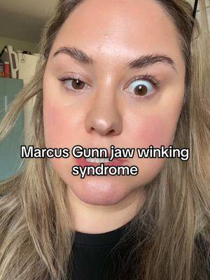 #marcusgunnsyndrome #marcusgunjawwinkingsyndrome #mgjws #chewing #eyelid #jawwinkingsyndrome 