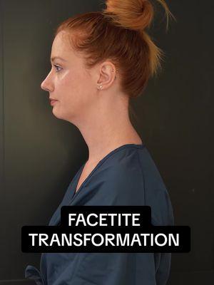 Trust the process, trust the results. 💉 At PFRANKMD, we guide you every step of the way to achieve the ultimate glow-up with FaceTite. From consultation to recovery, every moment is part of the journey to a more confident, rejuvenated you. Watch as this patient transforms, proving that the best results come from trusting the experts and embracing the process. Ready to start your journey? Let’s make it happen. #FaceTite #PFRANKMD #TrustTheProcess #GlowUp #FacialRejuvenation #ConfidenceBoost