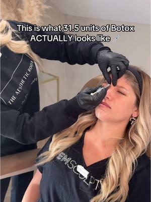 Madison received 31.5 units of Dysport for her first ever treatment! 💉 #aestheticinjector #nurseinjector #aesthetics #botox #beautytips #tox #dysportinjections #dysport 