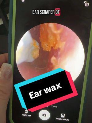 I was absolutely shocked when I saw how much earwax came out of this ear. . .  #Earwax  #Earwaxremoval  #Earcleaning  #Cleanears  #Ears #earwaxchallenge 