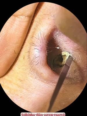 #earwaximpaction #memorialhearing #earwax #earwaxremoval #drwaxdropper #doctorelly #ellypourasef #drpimplepopper #wax #irrigation #earwaxirrigation #satisfyingvideo #satisfyingvideos #asmr 