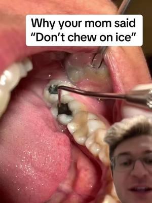 The reason you shouldn’t chew on ice is because it can caus vertical tooth fractures. These are difficult to restore and often go below the gum line.  #dentistry #brokentooth #brokenteeth #dentaltips #dentist #fyp #teeth #dentistry #viral 