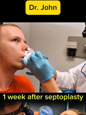 Septoplasty splint removal after 1 week surgery #septoplasty #splintremoval #splint #septum #surgery #sinusrelief 