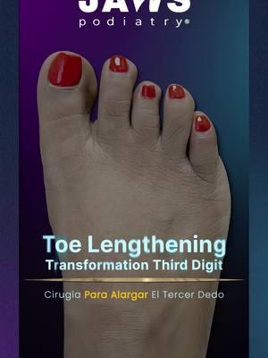 TOE LENGTHENING SURGERY❤️ 👠Cosmetic Foot Surgery  🇪🇸Speak Spanish  🏖️Miami, Florida ☎️954 922 7333 📍Link In Bio  #fyp #toelengthening #toelengtheningsurgery #brachymetatarsia #brachymetatarsiasurgery #braquimetatarsia #footsurgery #cirugiadepie #trending #pies #jawspodiatry 