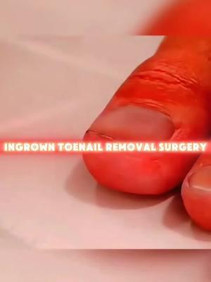 Ingrown Toenail Removal Surgery (3D Animation) #ingrowntoenail #ingrowntoenailremoval #ingrowntoenailsurgery #ingrowntoenailtreatment #ingrowntoenailremovalanimation #toenailremoval #toenailfungus #toenailsurgery #medical3danimation #3dmedicalanimation