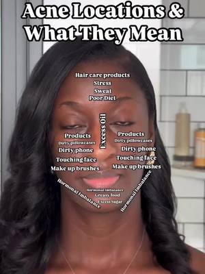 This is not a one size fits all but this skin map certainly gets you started. Once you know where to start, you can begin to treat your acne. So, the questions is, what does this map tell you about your skin? If you want the skincare products that help you clear up acne all over your face, comment the word ‘map’ #acneproblems #skincareroutine #acnesolution #skinmap #darkspotreatment #acneremover #darkspotsolution