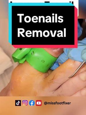 Effortless Ingrown Toenail Removal - Pain-Free Treatment In Minutes! | Miss Foot Fixer #toenail #toenailremoval #toenailtreatment #missfootfixer #toenailfungustreatment 