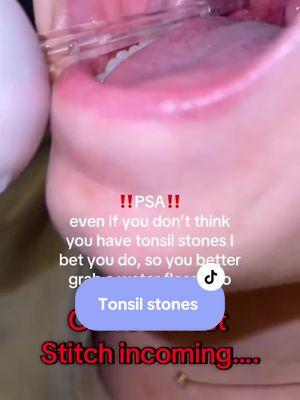 Tonsil stones are no fun!  #tonsilstones 